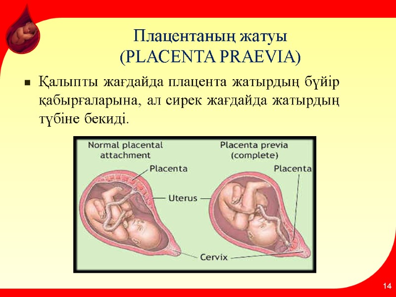 Плацентаның жатуы  (PLACENTA PRAEVIA) Қалыпты жағдайда плaцента жатырдың бүйір қабырғаларына, ал сирек жағдайда